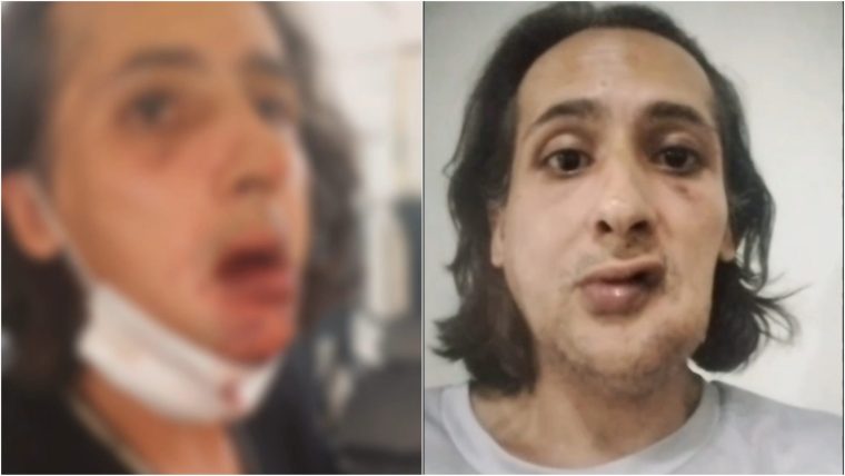 Homem denuncia agressão após reunião em cooperativa de transporte em Itapipoca e relata graves sequelas no rosto